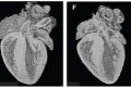 (left) Normal 4 hr old mouse heart.  (right) 4 hr old mouse heart in which Hand1 is upregulated.